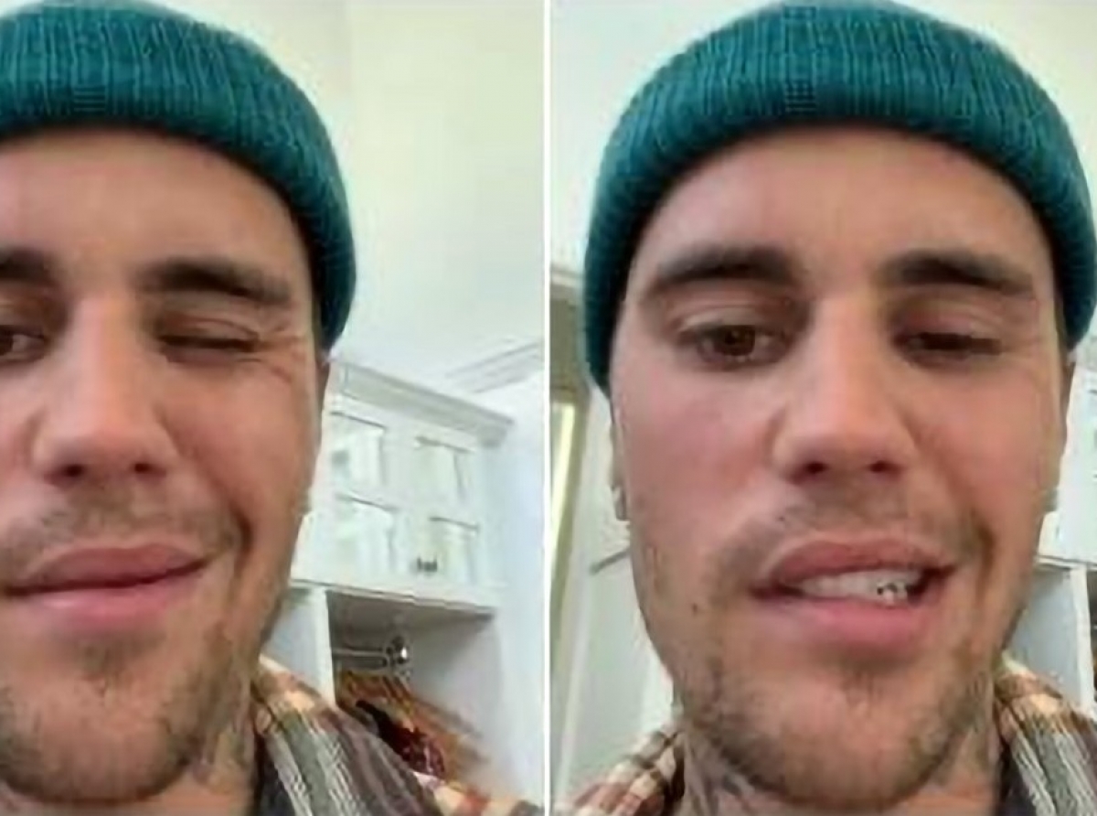 Justin Bieber a divulga cu el a sufri un paralisis facial