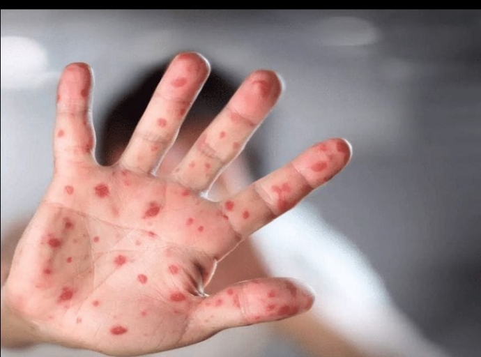 Aruba no tin ningun caso di Monkeypox ainda registra