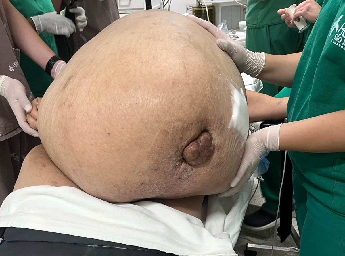 Muher a wordo opera di urgencia debi na un tumor di 46 kilo