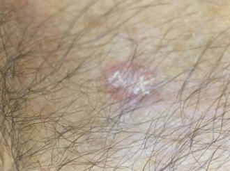 Wilhelmina Kanker Fonds preocupa cu no ta hayando estadisticanan riba e situacion di cancer na Aruba