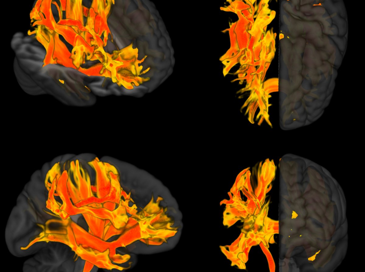 Rapport nobo a confirma cu presion halto di sanger ta yuda bo cerebro perde memoria