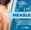 Departamento di Salud Publico trahando riba plan pa limita caso di Sarampi na Aruba