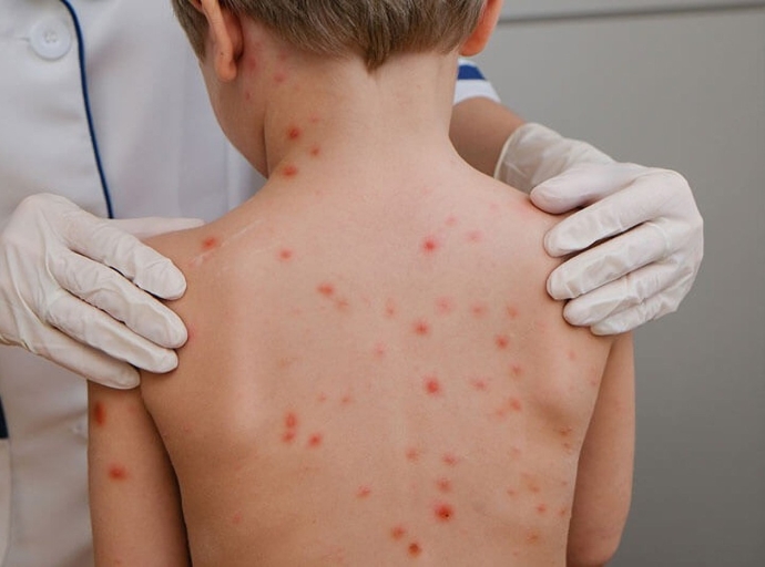 Varios mucha na scolnan preparatorio contagia cu malesa ‘Cendepaga’