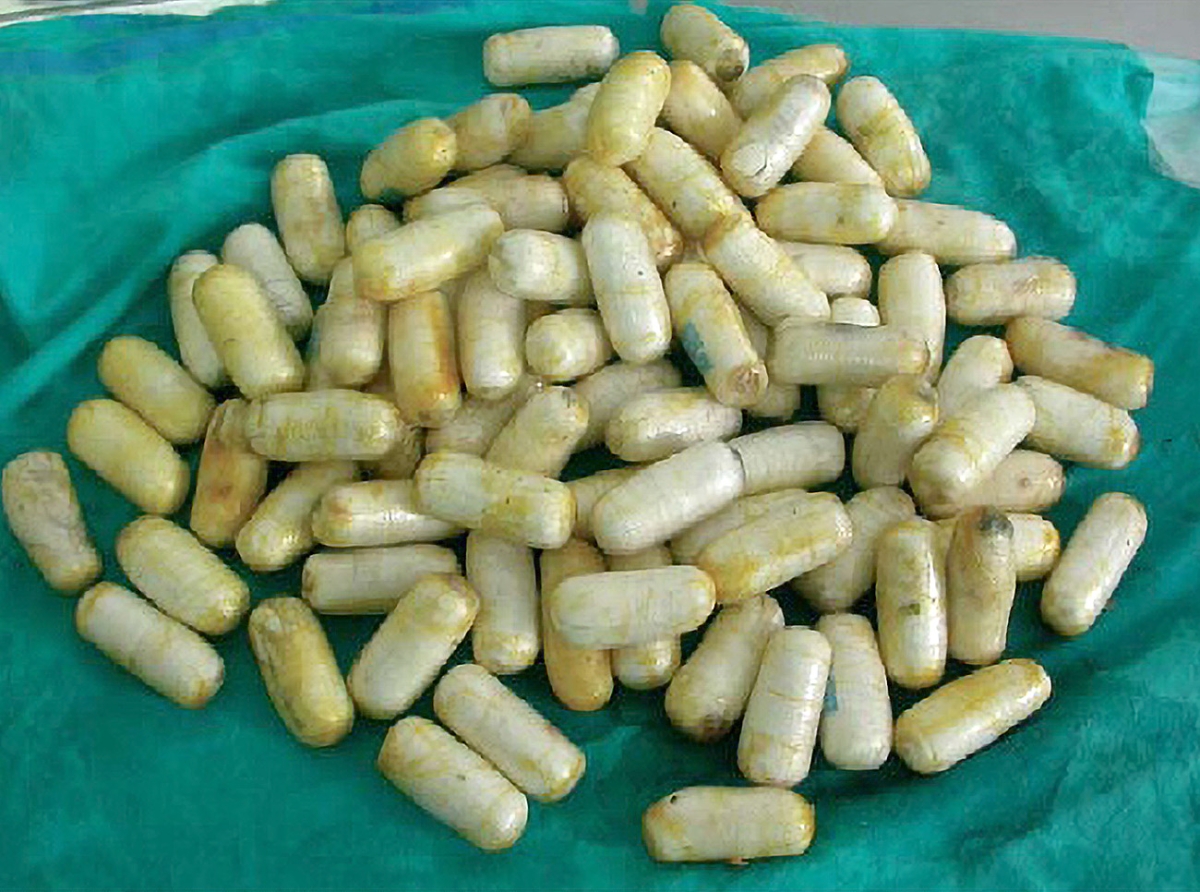 Hues no ta haya proba cu a causa morto di e homber cu bolitanan a rementa den stoma