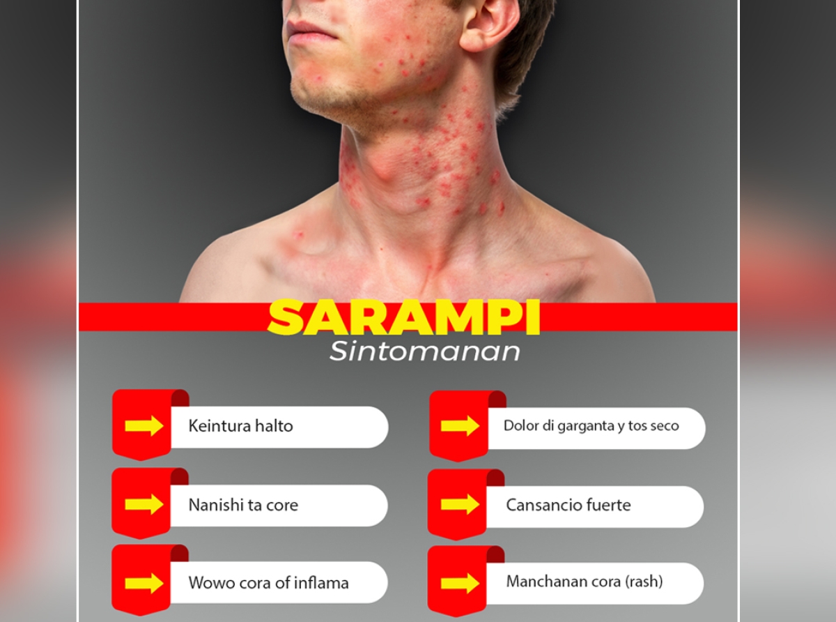 Caso di Sarampi conoci na Bonaire tabata di transito na Aruba